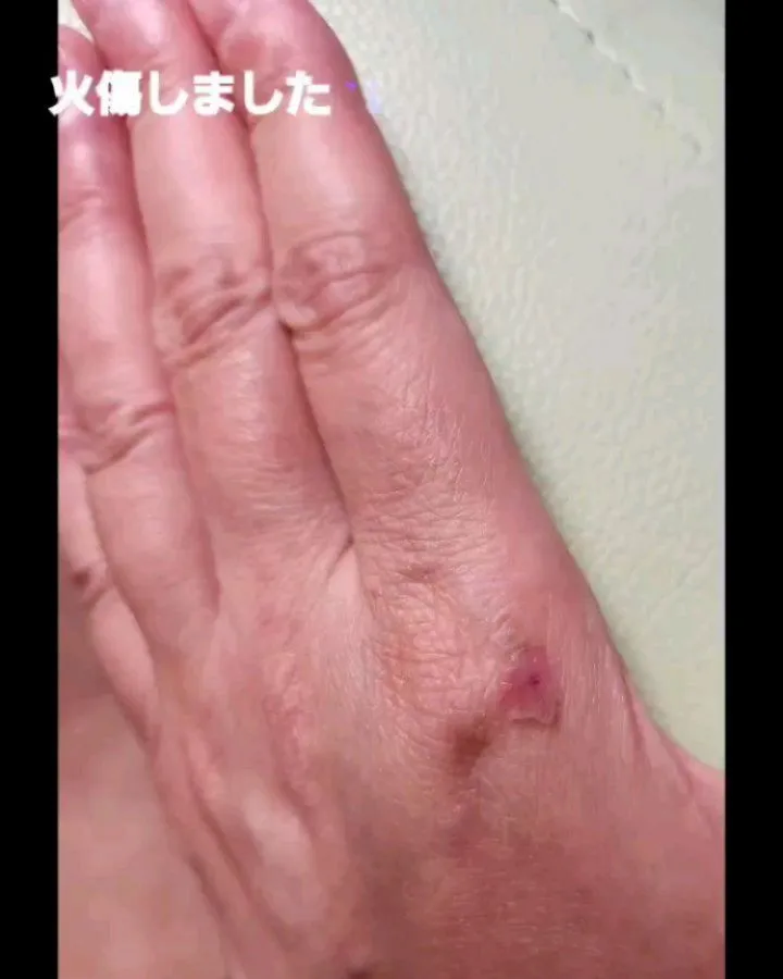 フェムケアのスキンオイルにはこんなアクシデントにも効力を発揮...